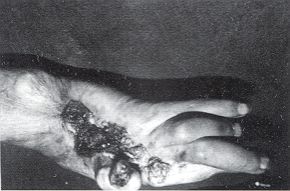 Fig. 7a - Epithélioma spinocellulaire sur séquelle de brûlure de la face dorsale de la main. Vue préopératoire.