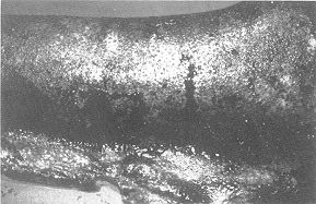 Fig. 2 - Biobrane removed 7 days post-excision. Bed ready for autograft.