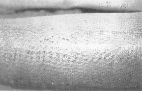 Fig. 4 - Mesh graft covered with Biobrane.