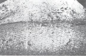Fig. 6 - Ten days after grafting. Biobrane removed and graft take achieved. Whole mesh closed.