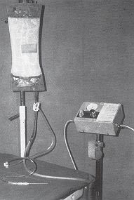 Fig. I - A simple device to facilitate the infiltration of epinephrine solution using pressure of the inflatable tourniquet.