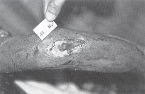 Fig. 2 - Brûlure profonde du coude droit avec expansion de l'olécrâne un mois après la brûlure.