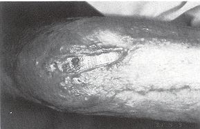 Fig. 3 - Décortication précoce exposant en partie le tissu spongieux.