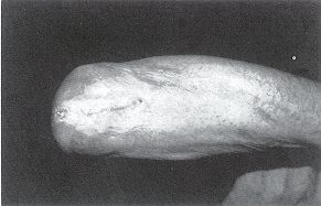 Fig. 4 - Cicatrisation complète trois mois plus tard.