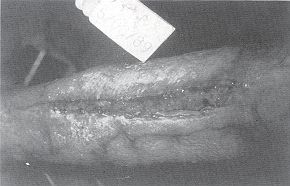 Fig. 6 - Séquestrectomie au Centre de Rééducation sans intervention chirurgicale ni anesthésie.