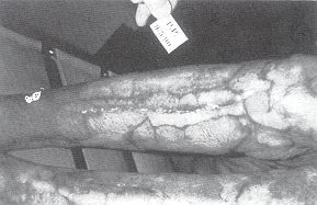 Fig. 7 - Cicatrisation complète centripète chez un grand brûlé hospitaiisé un an en Centre de Rééducation.