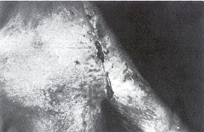 Fig. 1 - Diffuse and severe post-burn axillary contracture: anterior and posterior views.