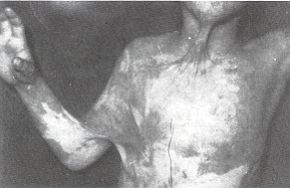 Fig. 2a - Post-burn axillary contracture: anterior view. 