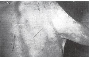 Fig. 2b - Post-burn axillary contracture: posterior view.