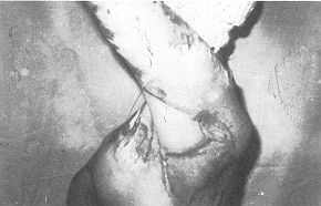 Fig. 3c - P 1 ost-burn axillary contracture: full abduction of the shoulder; the donor defect is covered by split-skin graft