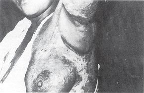 Fig. 4 - Late post-operative: flap filling the axillary defect. In obese patients the bulkiness of the flap is evident