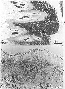Figs. la, b - Photomicrograph of hypertrophic scar section stained with anti-CD36 MoAb. CD36 expression can he observed in the suprabasal layer of epidermis (a) and sometimes in the same strata in the foci (b). Expression of CD36 antigens was also observed on endothelial cells of the dermal microvasculature (a) (x 250; scale bar 50 mm).