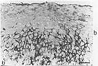 Fig. 2 - Photomicrograph of hypertrophic scar serial sections stained with anti-CD36 - (b) and anti-ICAM-1 