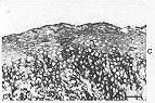 Fig. 2 - Photomicrograph of hypertrophic scar serial sections stained with anti-CD36  - (c) MoAbs. CD36 expression was present in the suprabasal layer of the epidermis