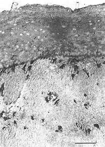 Fig. 3 - Photomicrograph of hypertrophic scar section stained with antiCD I lb MoAb. Keratitiocytes of full thickness of epidermis did not show expression of CD11b antigen while expression was present on dermal infiltrating cells (x 250, scale bar 50mm).