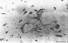 Fig. 4 - Photomicrograph of hypertrophic scar dermal section stained with anti-CD36 MoAb. Expression of CD36 antigens was observed on vascular endothelial cells (arrows) and on infiltrating cells (x 300, scale bar 25 mm).