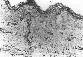 Fig. 5 - Photomicrograph of normotrophic scar section stained with antiCD36 MoAb. CD36 molecule expression was not detectable within the epidermis (x 200, scale bar 60 mm).