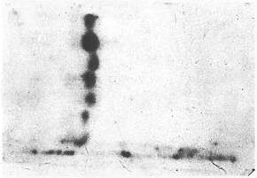 Fig. 3 - Immuno blot of keratins in normal (lanes 1, 2, 7), HTS (lanes 3, 4, 5) and keloid (lane 6). Primary antibody used was polyclonal rabbit anti-human keratin anti-body. Secondary antibody was `1 labelled protein A.