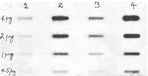Fig. 4 - Slot-blot analysis of keratin RNA expression in normal, hypertrophic scar and keloid epidermis. Total mRNA was extracted from normal (lane 1), HTS (lane 3 ) and keloid (lanes 2 and 4) by the GITC/phenol-chloroform extraction method. A serial dilution of RNA for each sample was applied directly onto a nylon membrane. The blot was hybridized with DNA specific for 50 kDa keratin (PKB-2) 1425 bp cloned into pst- I site on pl3R 322.