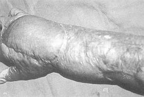 Fig. 1 - Résultat après libération et couverture par un lambeau chinois d'une rétraction de la face dorsal de la main.