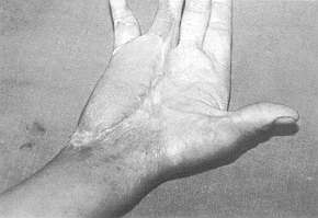 Fig. 3 - Résultat après libération d'une bride du bord cubital de la main et couverture par un lambeau sur la branche de l'artère cubitale.