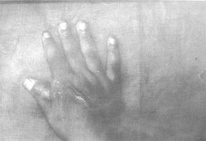 Fig. 4A - Rétraction de la l ère commissure.