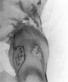 Fig. 1 - The design of the anterornedial fasciocutaneous thigh flap in a case of contracted groin and axilla.