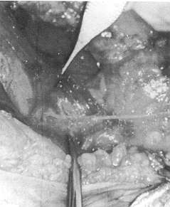 Fig. 2 - The vascular pedicle of the anterornedial fasciocutaneous thigh flap.