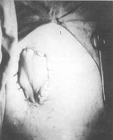 Fig. 5 - The flap transposed under skin tunnel to the recipient site.