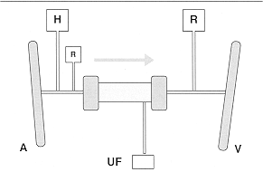 Fig. 1 - Simplified scheme of CAVH circuit. Blood flows in the direction of the arrow from artery (A) to the patient's vein, generally femoral, through the haerrofilter. A solution containing so jurn eparin (H) is perfused in the bloodline. The replacement fluid ca be supplied either arterially or venously. The ultraffitered liquid (UF)~'S' gathered in a urinometer placed at least 40 em below the haemofilter.the fluid obtained by ultrafiltration. Haemodialysis can sometimes be associated to CAVI---1 by administering a dialysate solution into the filter in opposit~on to the blood flow, thus increasing the clearance of solutes such as urea and creatinine.