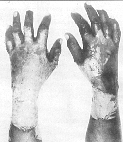 Fig. 1 - Fresh burns in a 25 year-old-man.