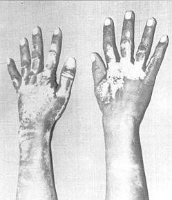 Fig. 2 - Burns completely healed within 8 day without residual scarring and with minimal depigmentation.