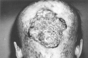 Fig. la - Recurrent and advanced squamous cell carcinoma on burn scar, occipital area; posterior view.