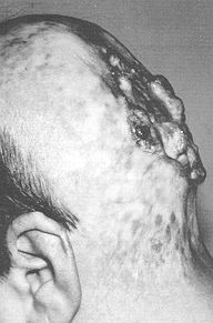 Fig. 1b - Recurrent and advanced squarnous cell carcinoma on burn scar, occipital area; lateral view.