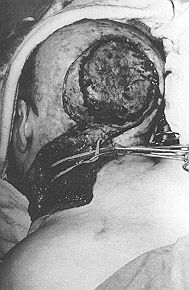 Fig. 1c - Large excision of tumoral tissue and cra lymph node dissection performed and recipient arter: for microanastomosis.