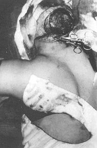 Fig. 1d - Left latissimus dorsi myocutaneous flap prepared with long vascular pedicle.