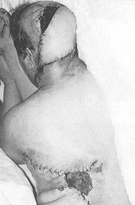 Fig. le - Latissimus dorsi myocutaneous flap su and microvascular anastomosis completed. Donor area mostly primarily. Split-thickness skin graft in only a small area