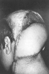 Fig. 1f - Flap and split-thickness skin graft on tenth day after flap operation