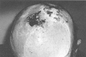 Fig. 2a - Basal cell carcinoma in parietal region.