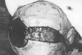 Fig. 2b - Excision of tumour and cranium.
