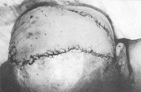 Fig. 2d - Radial artery flap on parietal region.