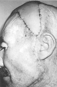 Fig. 2e - Two weeks after flap operation.