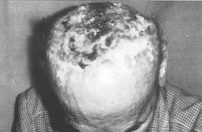 Fig. 3a - Extensive bum carcinoma on scalp a cranium with tumour.