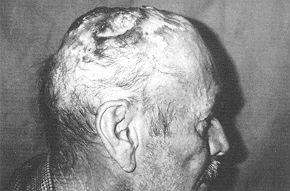 Fig. 3b - Extensive burn carcinoma on scalp and cranium with tumor.