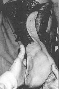 Fig. 3d - The latissimus dorsi myocutaneous free vascular pedicle.