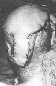 Fig. 3e - Latissimus dorsi myocutaneous flap or parieto-occipital area microvascular anastomosis performed in the left neck vessels.