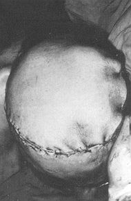 Fig. 3f - Latissimus dorsi myocutaneous fia microvascular anastomosis performed in the left neck vessels.