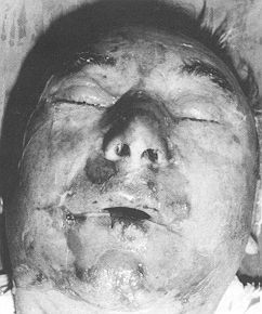 Fig. la - Superficial bum covered by amniotic membrane. Immediately after accident.