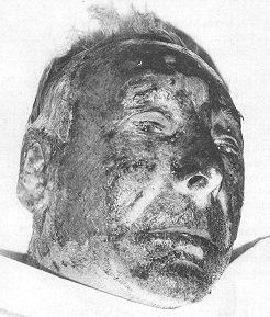 Fig. 1b - During treatment.