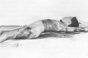 Fig. 2a - Nine-year-old boy with deep bum. Immediately after accideni